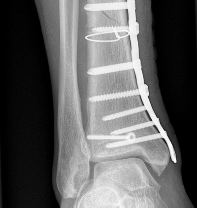 Bild Siloah St. Trudpert Klinikum, Orthopaedie und Unfallchirurgie, Roentgenbild eines Knochen mit Schrauben