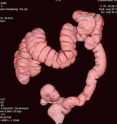 Bild Siloah St. Trudpert Klinikum, Radiologie, Darstellung eines Darms 