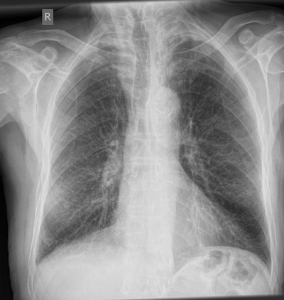 Bild Siloah St. Trudpert Klinikum Pforzheim, Radiologie, Roentgenaufnahme einer Lunge