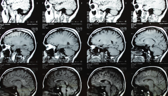 Bild Siloah St. Trudpert Klinikum, Institut für Diagnostische und Interventionelle Radiologie, Abbildung des Gehirns 