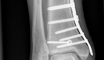 Bild Siloah St. Trudpert Klinikum, Klinik für Orthopädie und Unfallchirurgie, Röntgenbild eines Knochens, auf dem Schrauben zu erkennen sind 