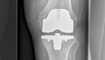Bild Siloah St. Trudpert Klinikum, OUC, Roentgenbild, auf dem ein Knie-Implantat erkennbar ist 